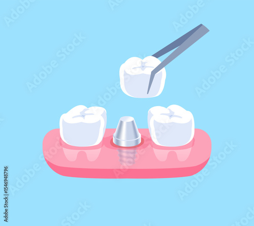 Dental Implant illustration vector design. Dental care concept.