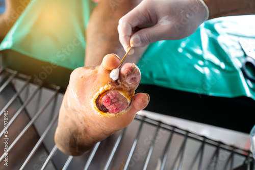 wound dressing wound infection by nurses.The doctor cleaning wound patient at foot: diabetic foot/pus from the wound.
