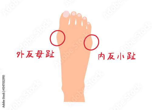 外反母趾と内反小趾の主線なしシンプルイラスト素材