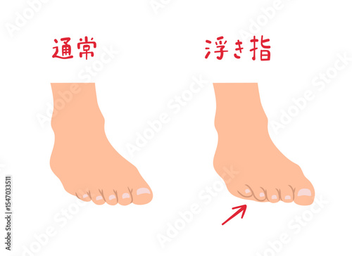 浮き指と通常の足の形の主線なしシンプルイラストセット