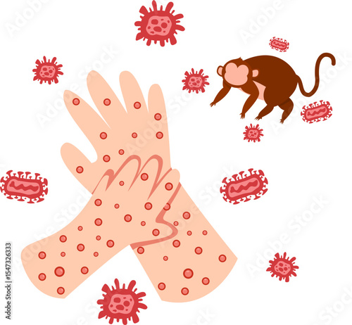 Pustule-Covered Hands, Monkey, and Virus Cells: A Visual Representation of Disease.