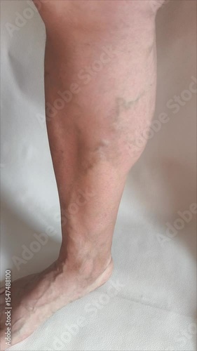 Varicose veins on the legs of a woman in close-up on a white background.  Cardiovascular diseases. Veins on the leg.