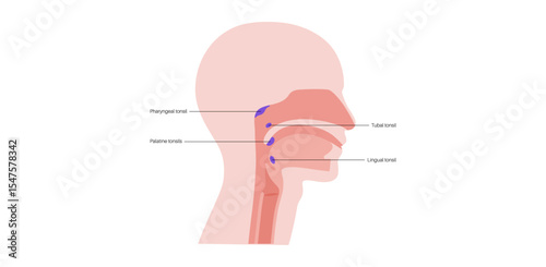 Adenoid medical poster