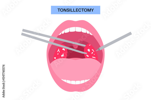 Tonsillectomy procedure poster
