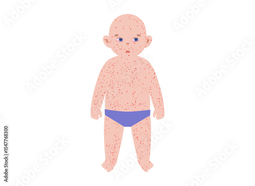 The most common viral rashes
