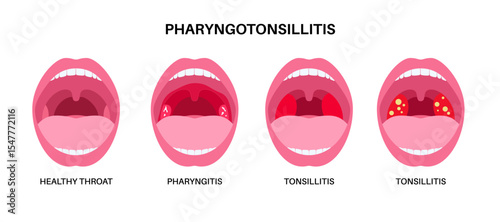 Pharyngotonsillitis oral disease