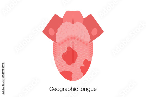 Geographic tongue poster