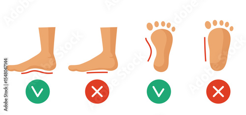 Healthy foot and flatfoot. Vector illustration isolated on white background.