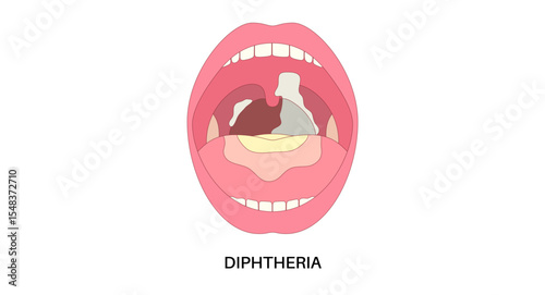 Diphtheria medical poster