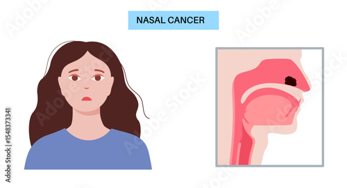 Nasal cancer poster