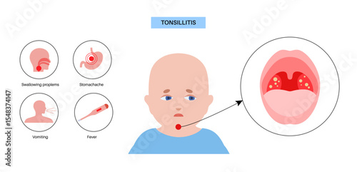Tonsillitis Oral Desease