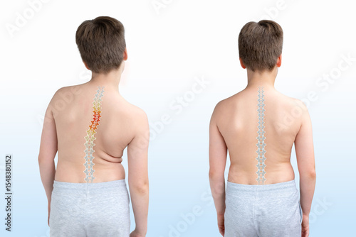 Child's back showing spinal curvature comparison, scoliosis pain, kyphosis, before and after, orthopedic treatment or physical therapy, Posture correction and spinal health