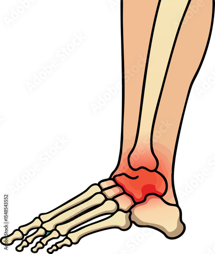 Anatomical illustration of human ankle joint with inflammation highlighting bones and soft tissues 