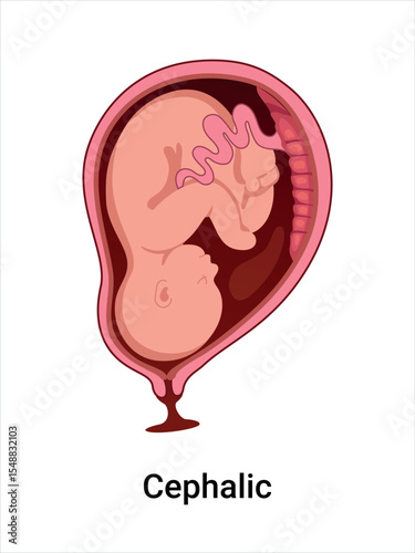 Cephalic baby positions in the uterus during pregnancy. Pathology. Detailed medical vector illustration. Fetus with umbilical cord, placenta.
