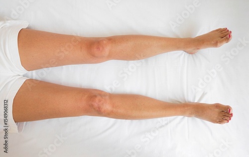 closeup of woman legs lying flat on white bed in bright medical setting, swelling, concept of lymphedema diagnosis, recovery, orthopedic assessment, physical therapy care
