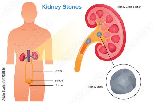 Human kidney Stones, kidney anatomy cross section and kidney stone illustration