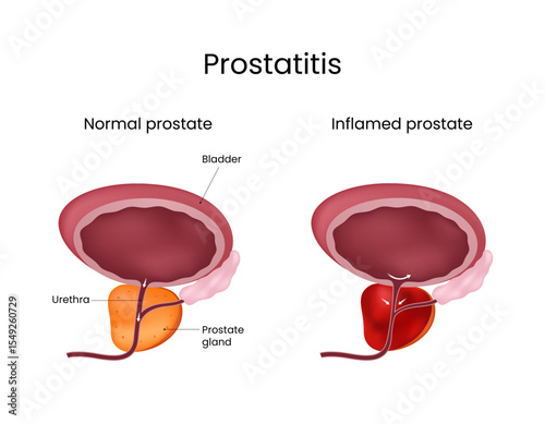 Prostatitis Comparison of Normal and Inflamed Prostate Gland