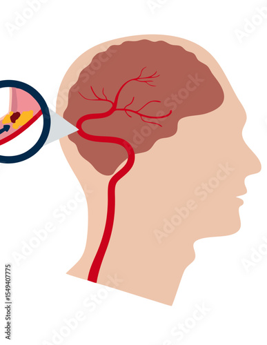 Brain Blood Clot and Stroke Diagram: Cerebral Artery Blockage