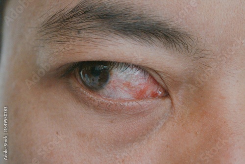 Detailed shot of a bloodshot and irritated human eye