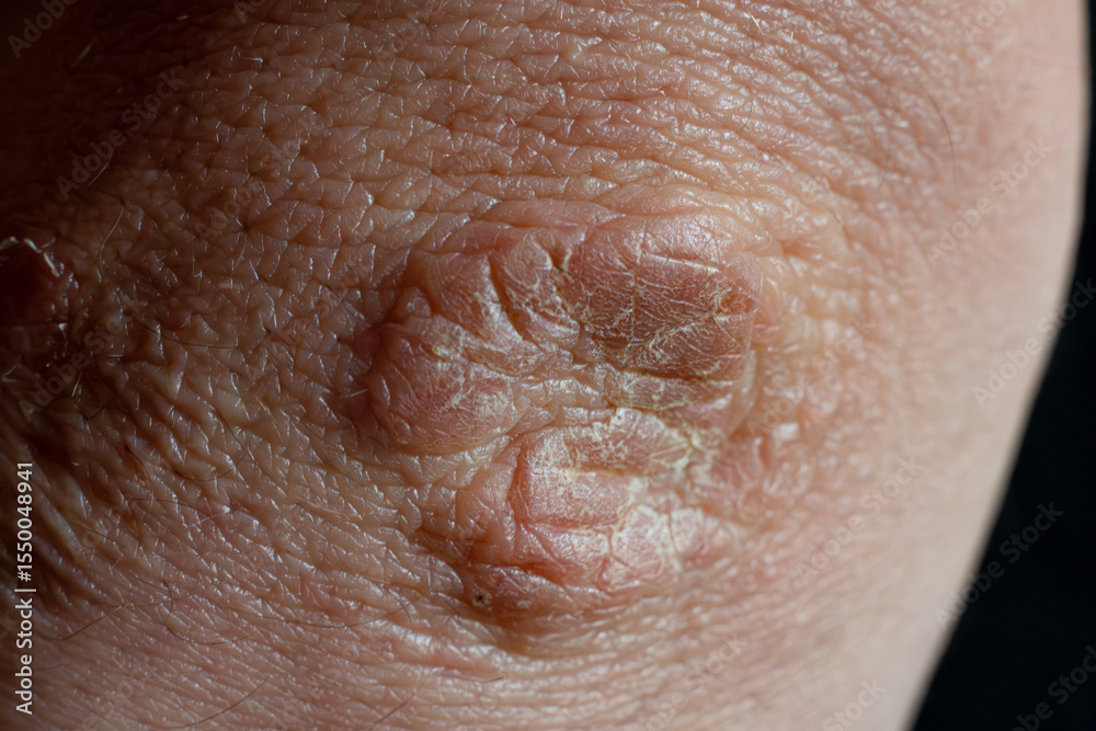 Fototapeta premium Close up of old scar tissue on an elbow