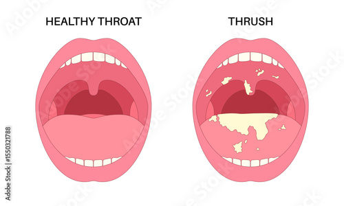 Thrush disease poster