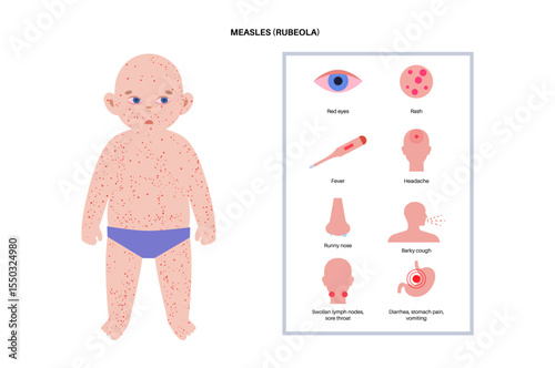 Measles or rubeola symptoms.