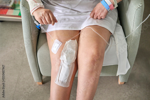 Elderly woman sits in an armchair after knee replacement surgery, connected to an IV fluid line. Her covered wounds reflect the early postoperative stage of recovery.