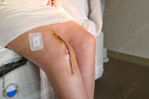 Unrecognizable elderly woman shows the stapled surgical wound from a knee arthroplasty, covered with an iodine-based natural disinfectant while sitting on a hospital bed