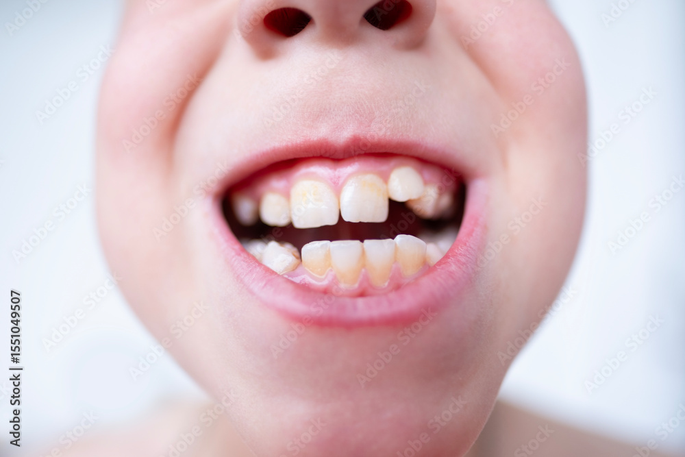 Naklejka premium close-up teeth of child, boy 10 years old new tooth fang in mouth with finger, concept children's health, pediatric dentistry, dental correction