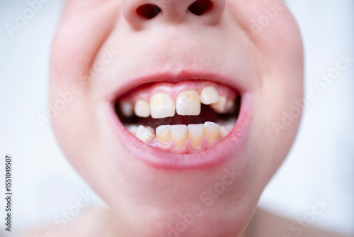 close-up teeth of child, boy 10 years old new tooth fang in mouth with finger, concept children's health, pediatric dentistry, dental correction
