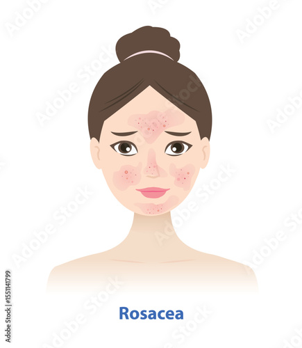 The woman face of rosacea skin illustration on white background. Rosacea causes redness, sometimes bumps or pimples, usually on the cheeks, nose, chin and forehead. Skin care and beauty concept.