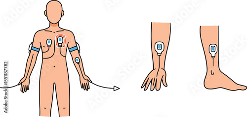 Electrocardiogram (ECG) Lead Placement A Comprehensive Guide to Electrode Positioning on the Body