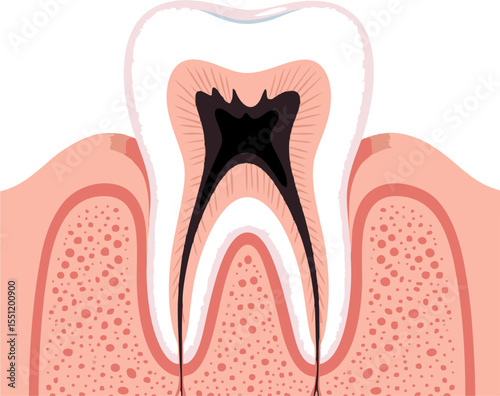 Detailed Illustration of a Tooth with Extensive Root Canal Decay