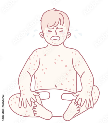 Illustration depicting a distressed baby that is visibly showing numerous signs of skin irritation and discomfort