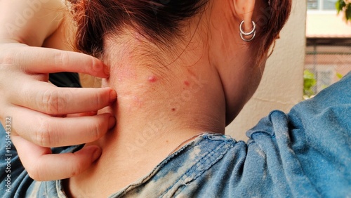 portrait the rash hives allergy and inflammation skin,reaction and urticaria,scar and freckles, urticaria stigma and eczema,epidermis blister rosacea on the neck,health care and medical concept.