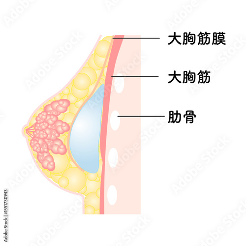 バッグ豊胸_大胸筋膜下法