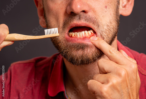 Man brushing teeth suffers from inflamed, bleeding gums as a symptom of periodontitis, poor oral hygiene and dental care