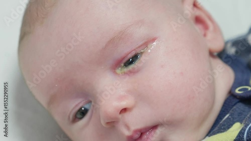 Baby eyes with eye mucus in selective focus. Disease tear ducts tons of newborns close up. Nasolacrimal duct obstruction in baby it is a blockage of the lacrimal drainage system. 