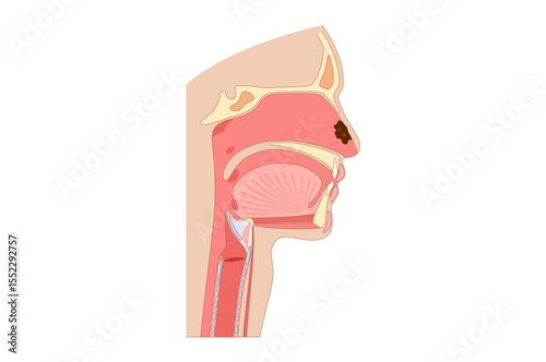 Nasal cancer poster