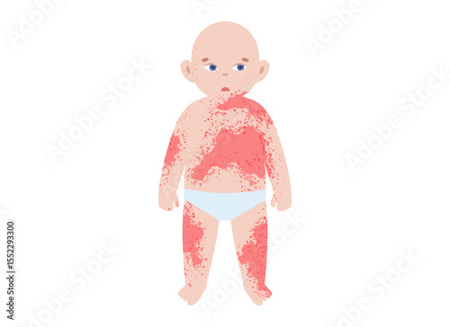 The most common viral rashes