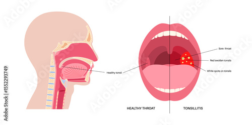 Tonsillitis medical poster