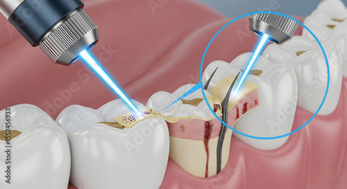 Dental Laser Treatment Cavity Filling, Laser Dentistry, Teeth Restoration, Oral Health, Tooth Decay.
