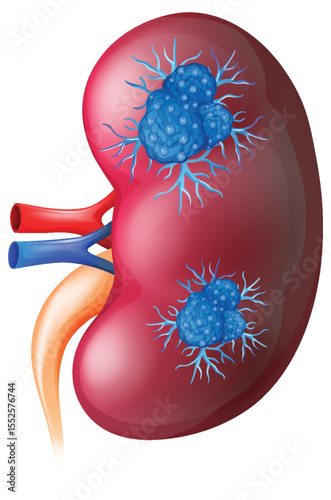 Detailed Kidney Anatomy with Tumors Illustration