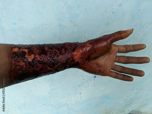 Detailed texture of skin affected by a burn wound. Close-up view showcasing the damage.