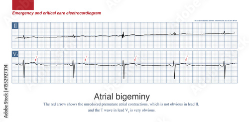 When atrial bigeminy is not transmitted to the ventricle, it will form a special bradyarrhythmia, which is easy to be misdiagnosed as sinus bradycardia or 2:1 sinoatrial block.
