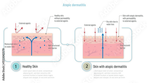 Healthy skin compared to skin with atopic dermatitis showing permeability to external agents