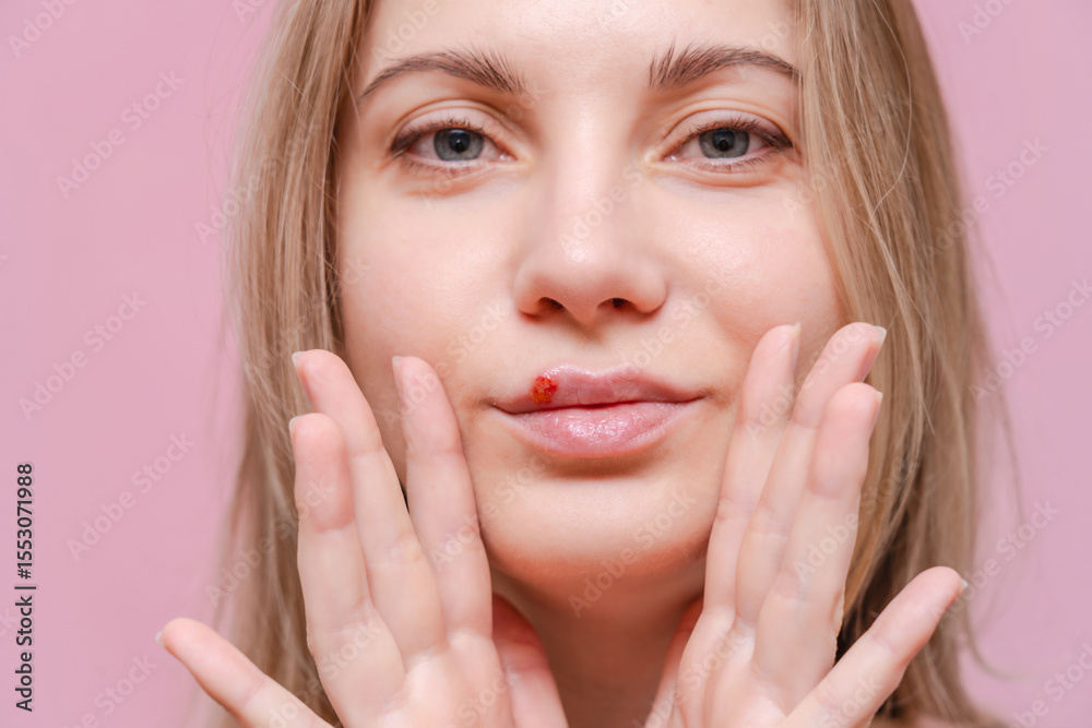 Closeup on herpes cold sore on mouth of young woman with pink background. Herpes blisters Closeup on herpes cold sore on mouth of young woman with pink background. Herpes blisters