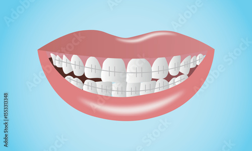 Isolated teeth on white background, smile with white teeth and braces.
