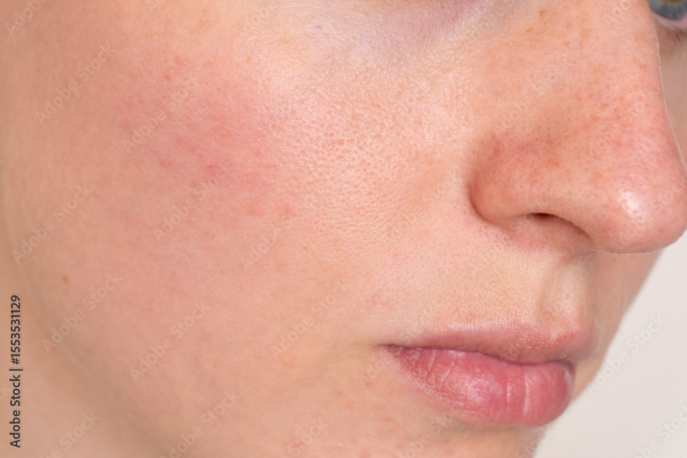 Extreme close-up of woman’s cheek and nose with enlarged pores, light redness and natural skin texture. Perfect for skincare, dermatology, cosmetic testing, or educational health visuals. Extreme close-up of woman’s cheek and nose with enlarged pores, light redness and natural skin texture. Perfect for skincare, dermatology, cosmetic testing, or educational health visuals.