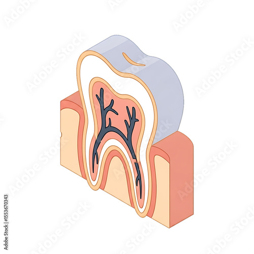 Cross-section of a tooth showing decay and nerves.